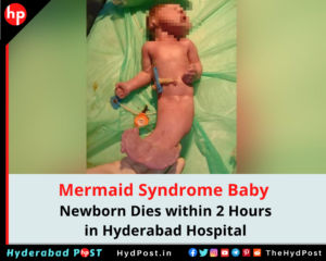 Read more about the article Mermaid Syndrome Baby, Newborn Dies within 2 Hours in Hyderabad Hospital